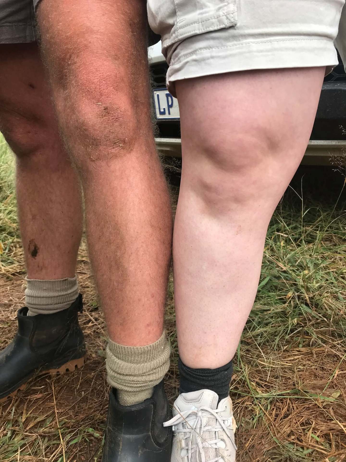 Angelo's badly sunburned legs beside a teammate's pale legs after a long day in the veld sun
